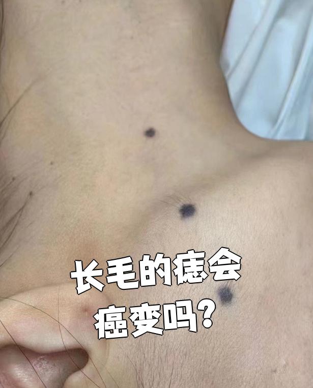 长毛的痣通常是黑毛痣,属于良性病变,一般不会癌变
