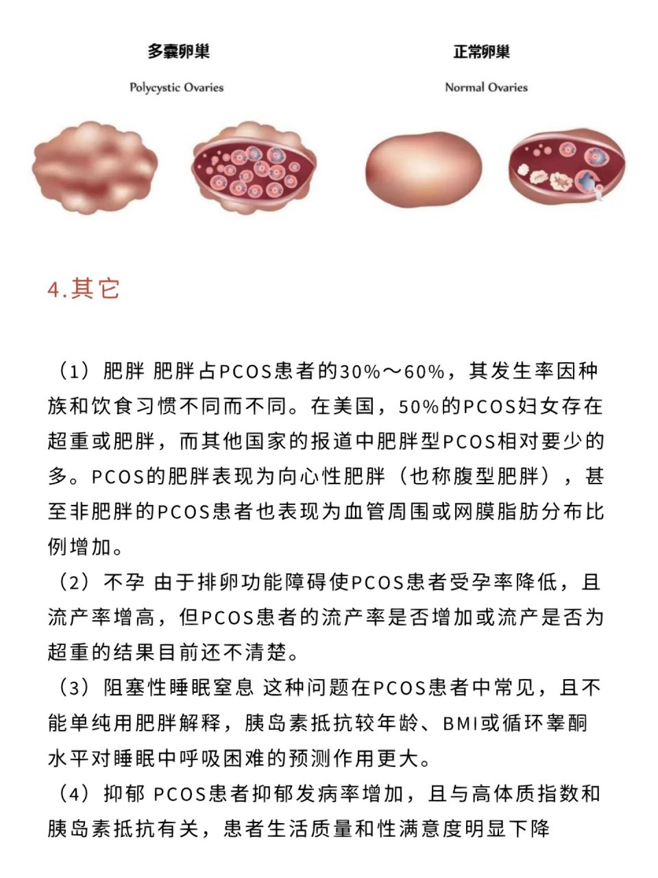 多囊卵巢综合症 多囊卵巢综合症的临床表现 1.月经紊乱 2.