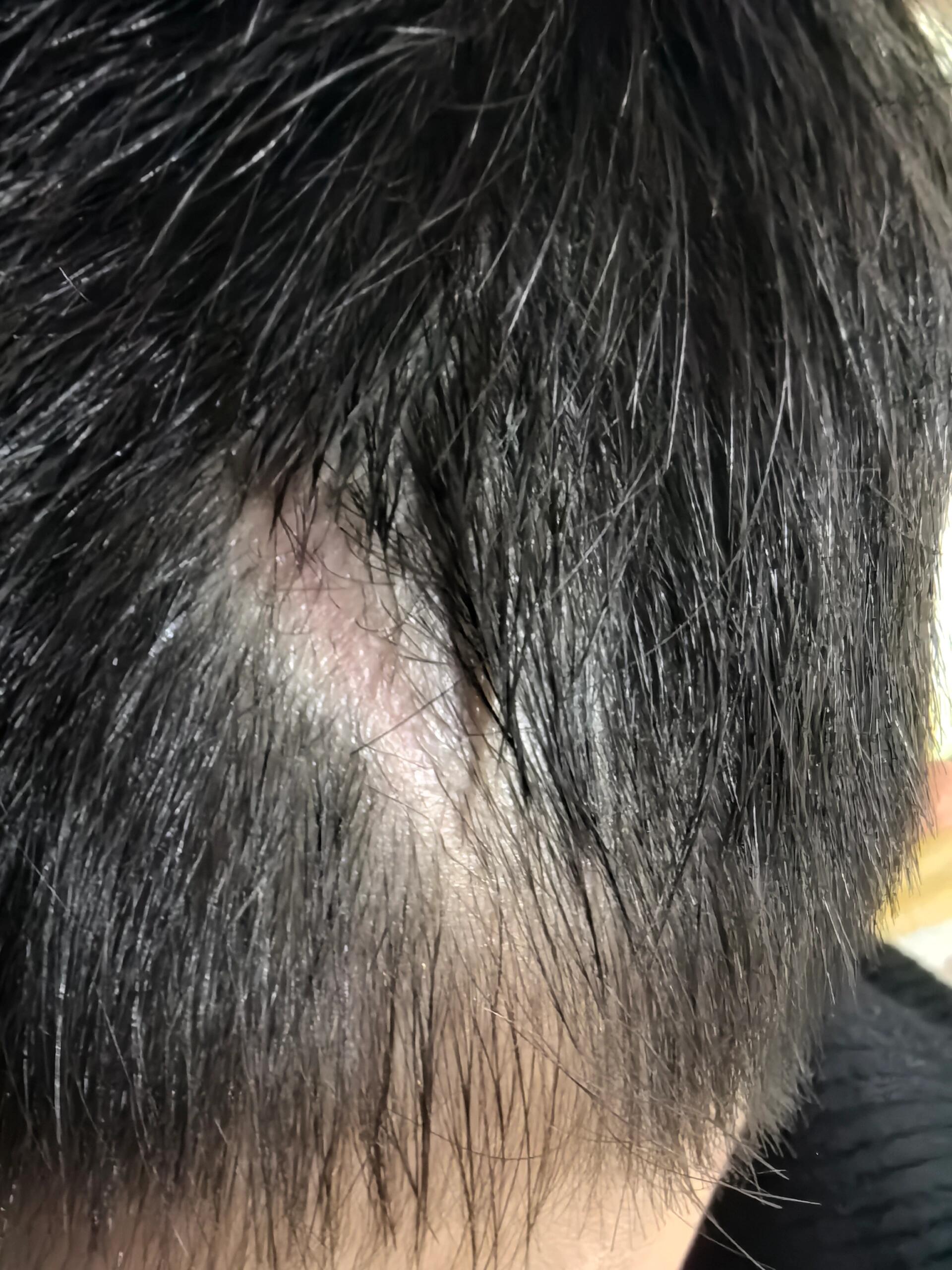 小孩摔伤头缝合后毛囊受损不长头发 小孩摔伤头缝合后,已经1个月了