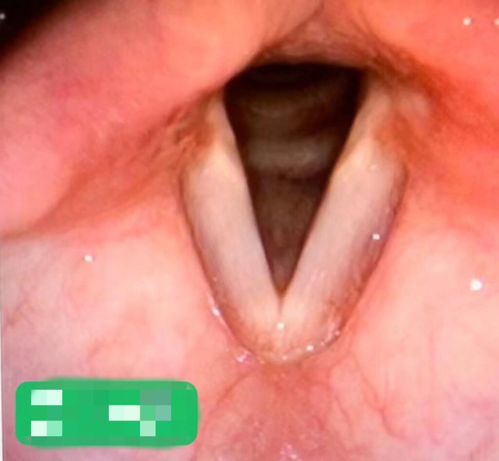 声带小结 早期图片