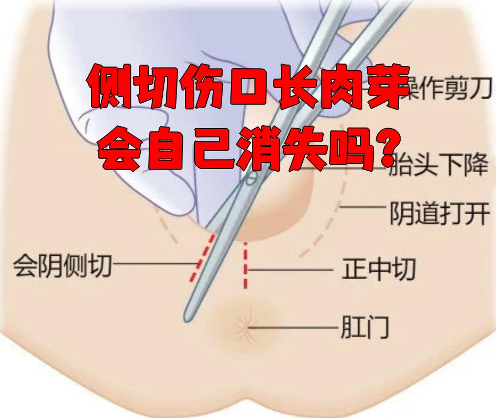 侧切伤口长肉芽一般不会自己消失