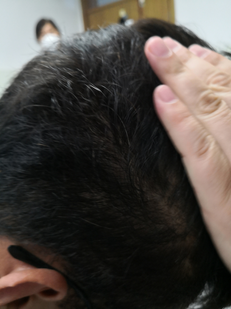 头皮寻常疣症状经过一段时间的治疗已经恢复正常皮肤.