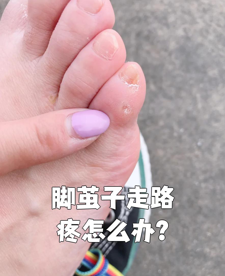 脚茧子走路疼怎么办?