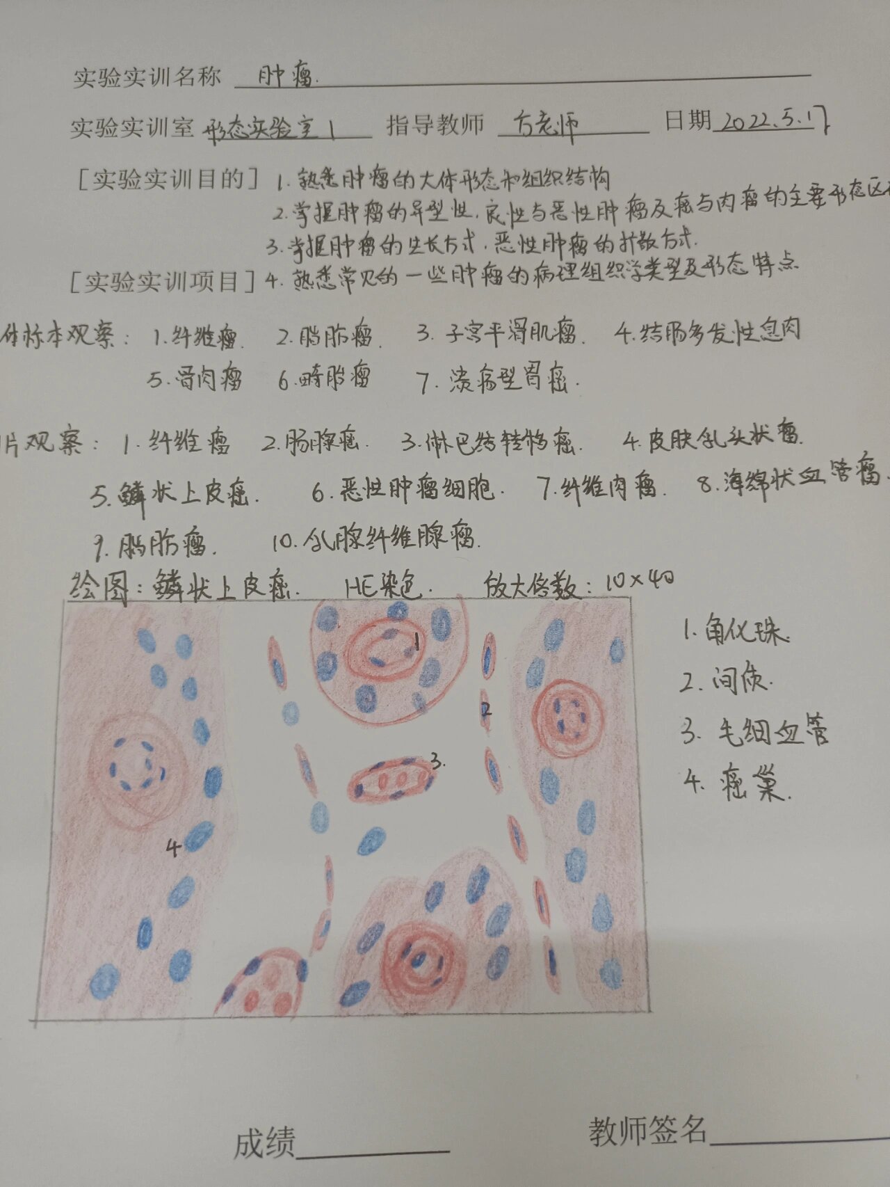 鳞状上皮癌红蓝铅笔绘图 病理学与病理生理学红蓝铅笔绘图