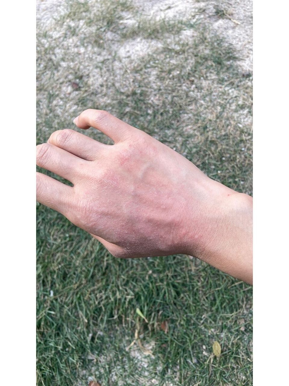 秋天手干的起疹子,试试这两个药,效果特别好 我过敏肤质,一到秋天皮肤