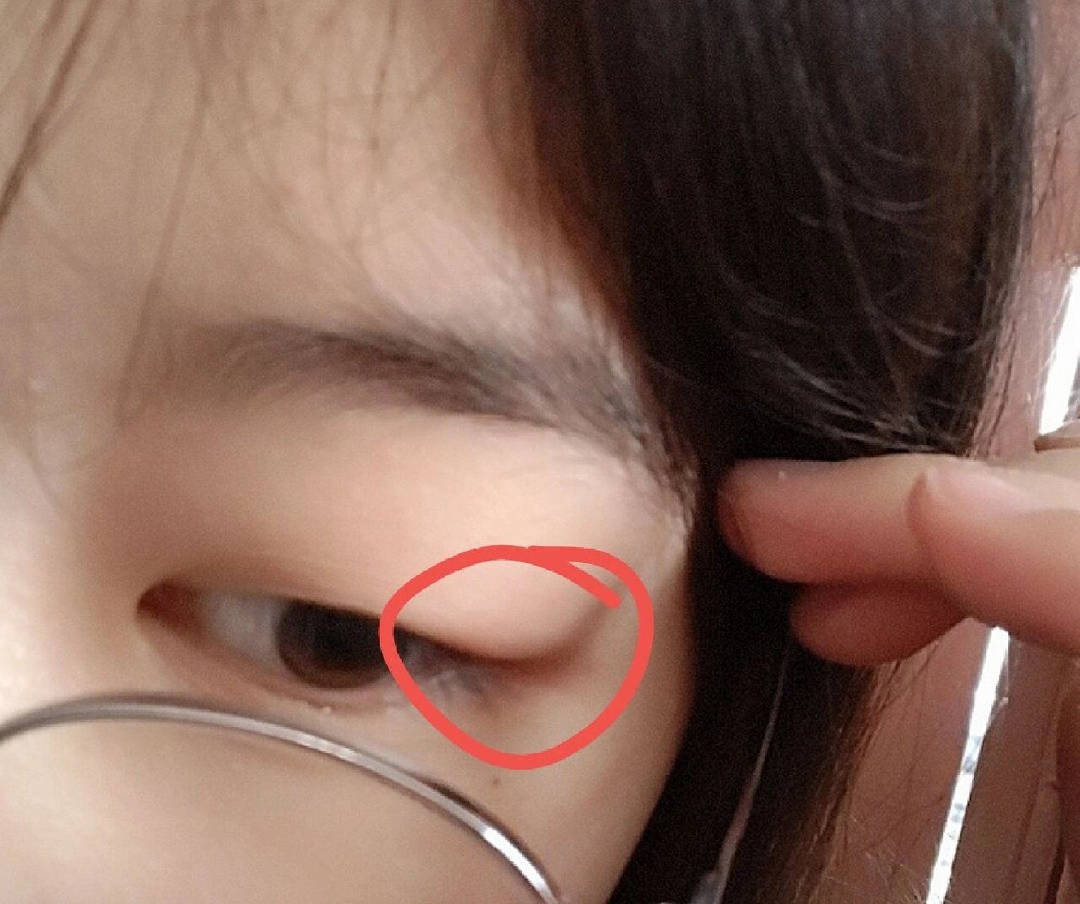 睑腺炎,科普 前一天晚上熬夜看手机,然后一起来发现右眼眨眼时疼痛,用