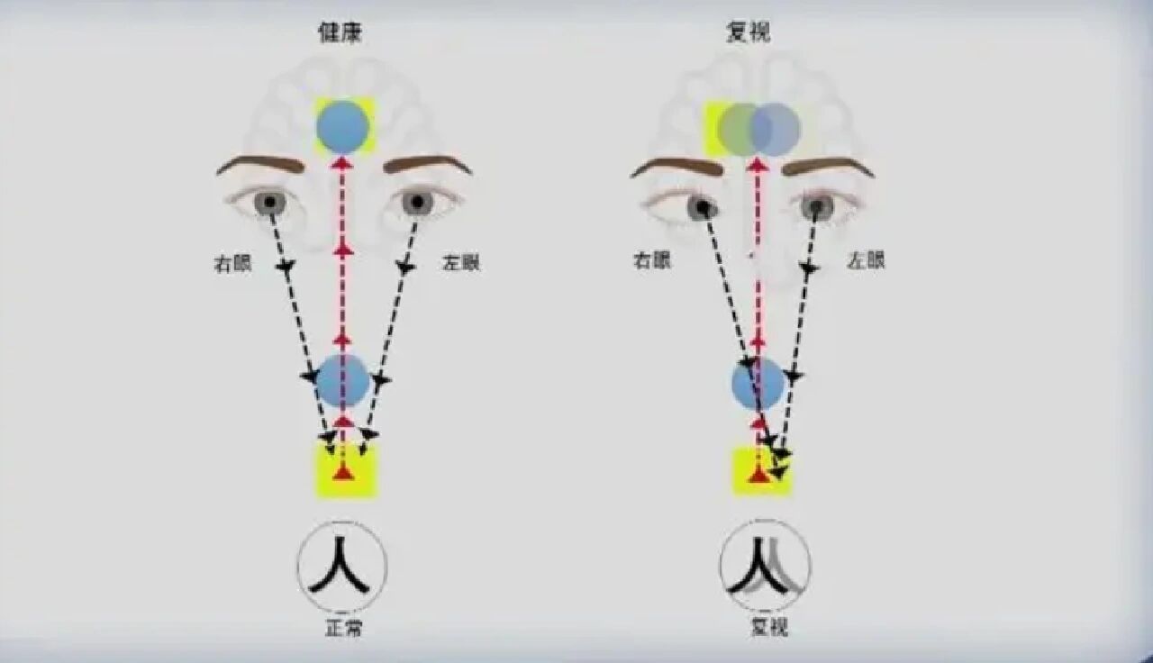 什么是复视?