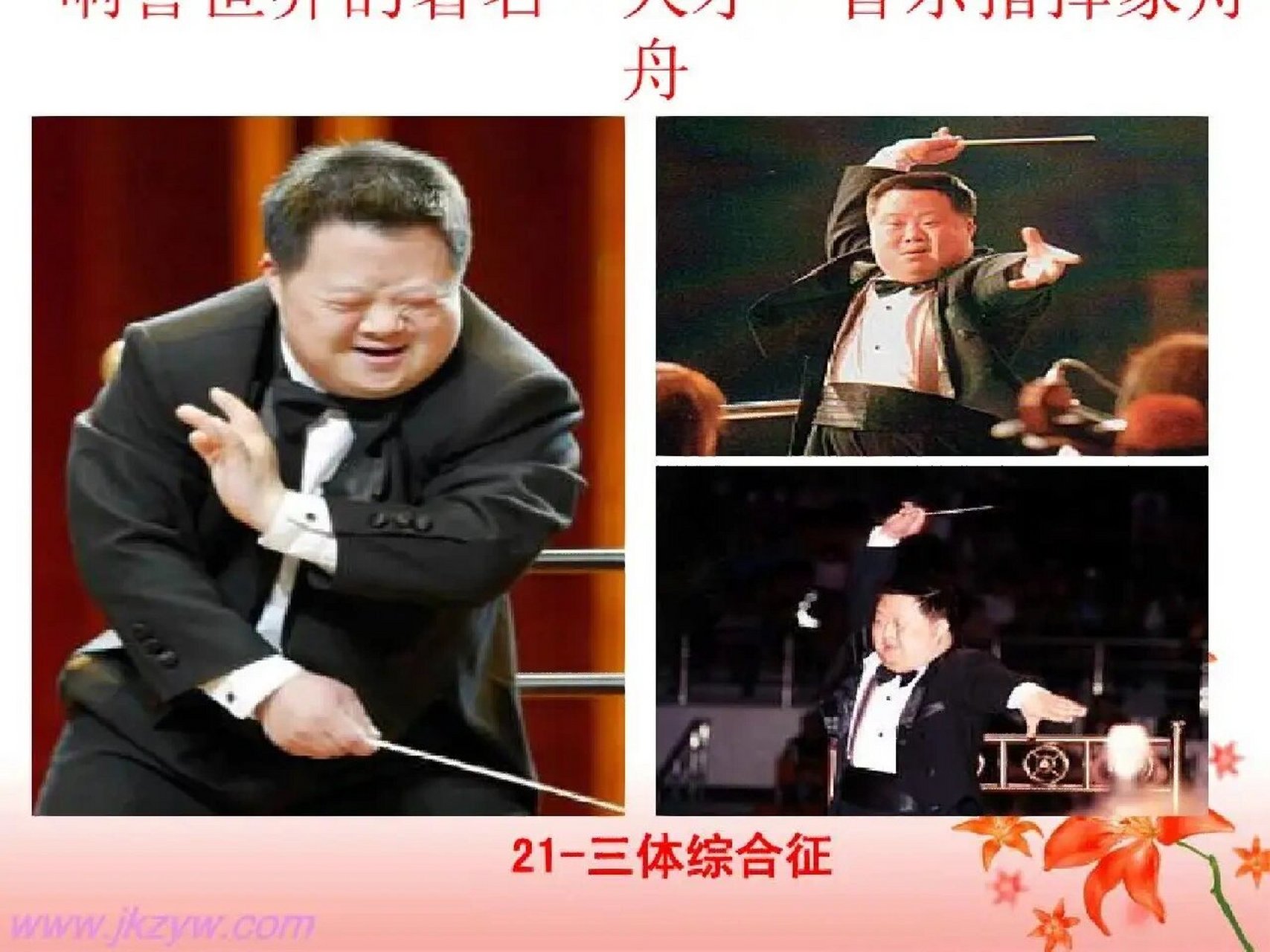 小儿唐氏综合征 唐氏综合征(down syndrome)又称21-三体综合征,先天