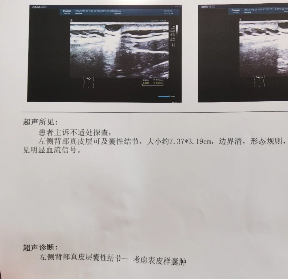 先说皮脂腺囊肿.这个病是因为皮脂腺分泌太多,导管堵住了形成的