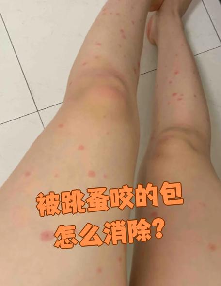被跳蚤咬的包叫丘疹性荨麻疹,也叫虫咬性皮炎