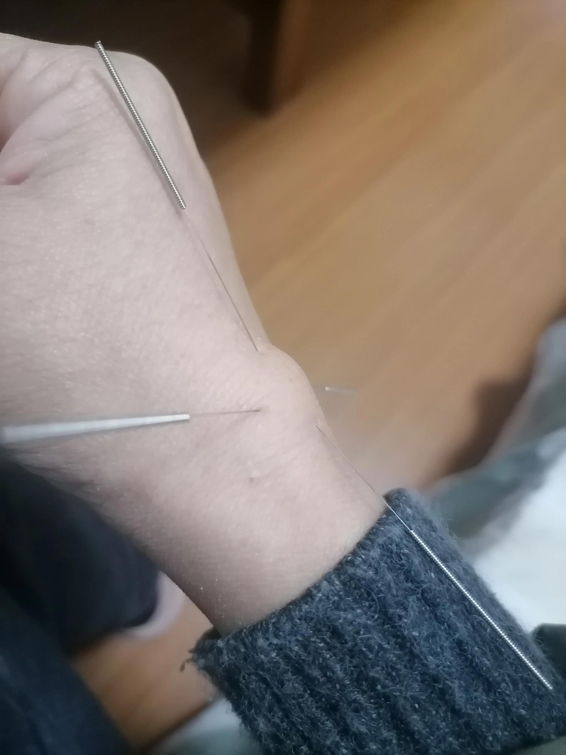 零消费,不做手术,自己治愈腱鞘囊肿