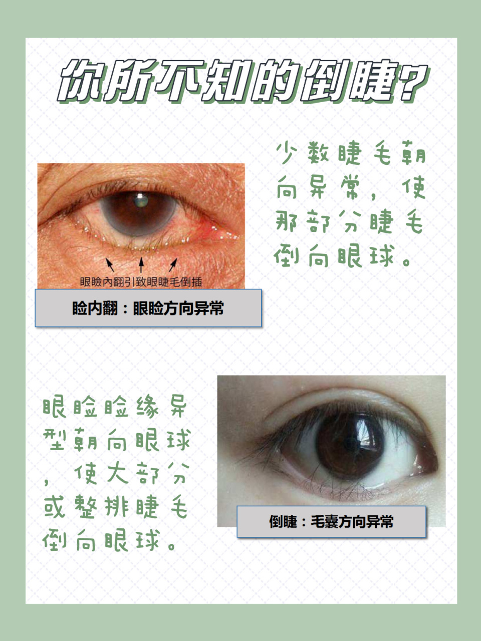 涨知识丨得了倒睫怎么办 98倒睫俗称"倒睫毛".