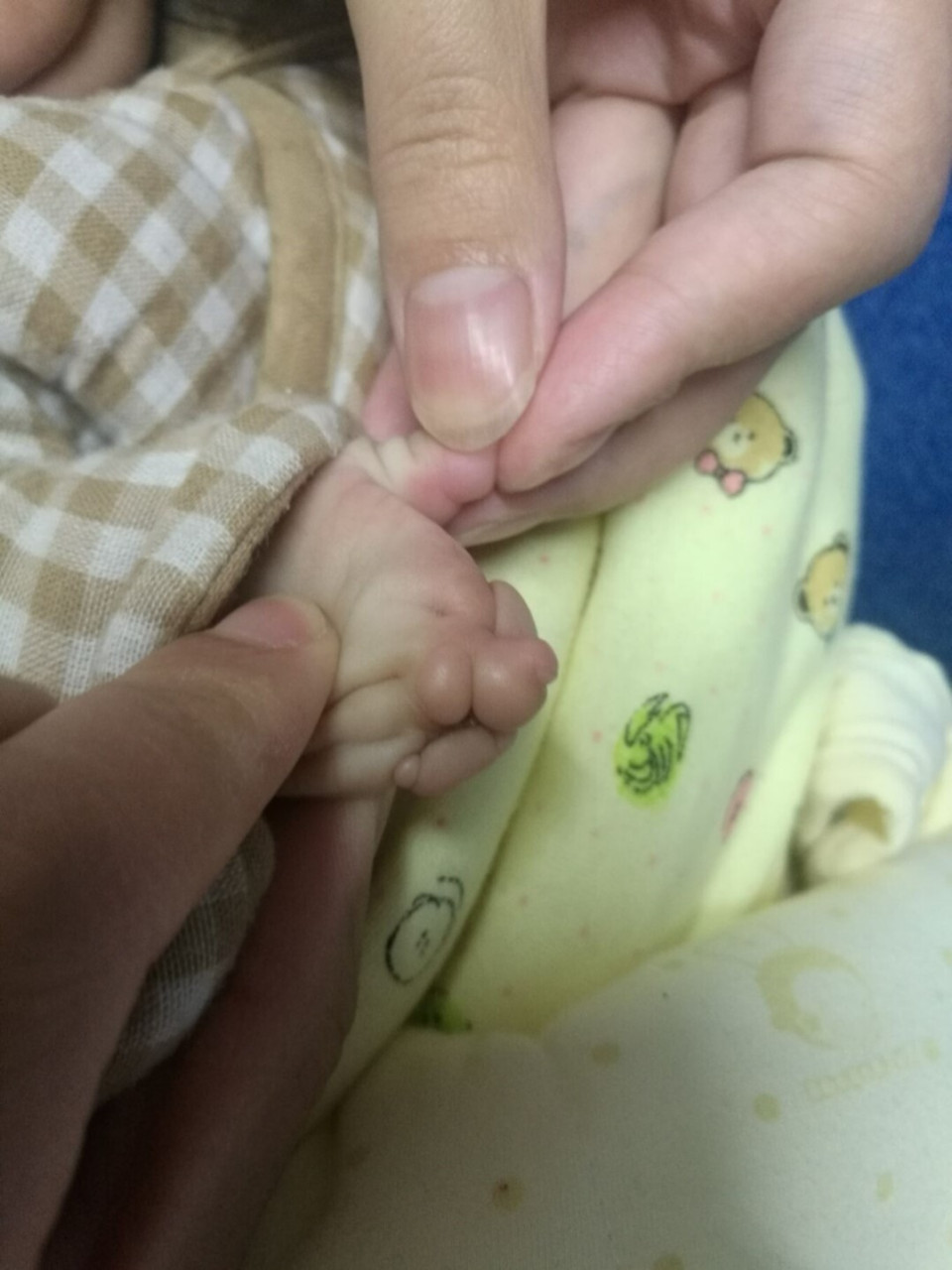 束带综合症 束带综合症,是由于宝宝在子宫里面被羊膜束带束缚导致的