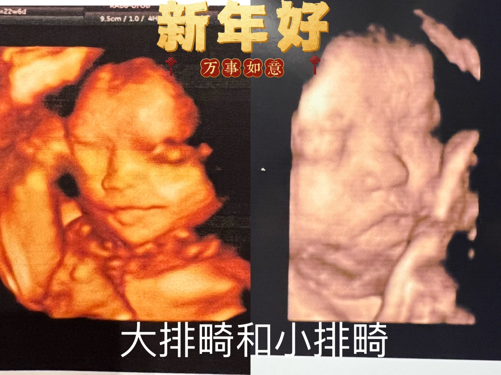 大排畸和小排畸对比照 大排畸的宝宝还是很秀气的