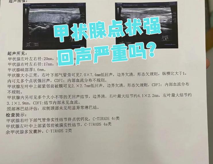 甲状腺点状强回声在超声图像上表现为甲状腺结节内部出现的高萌度
