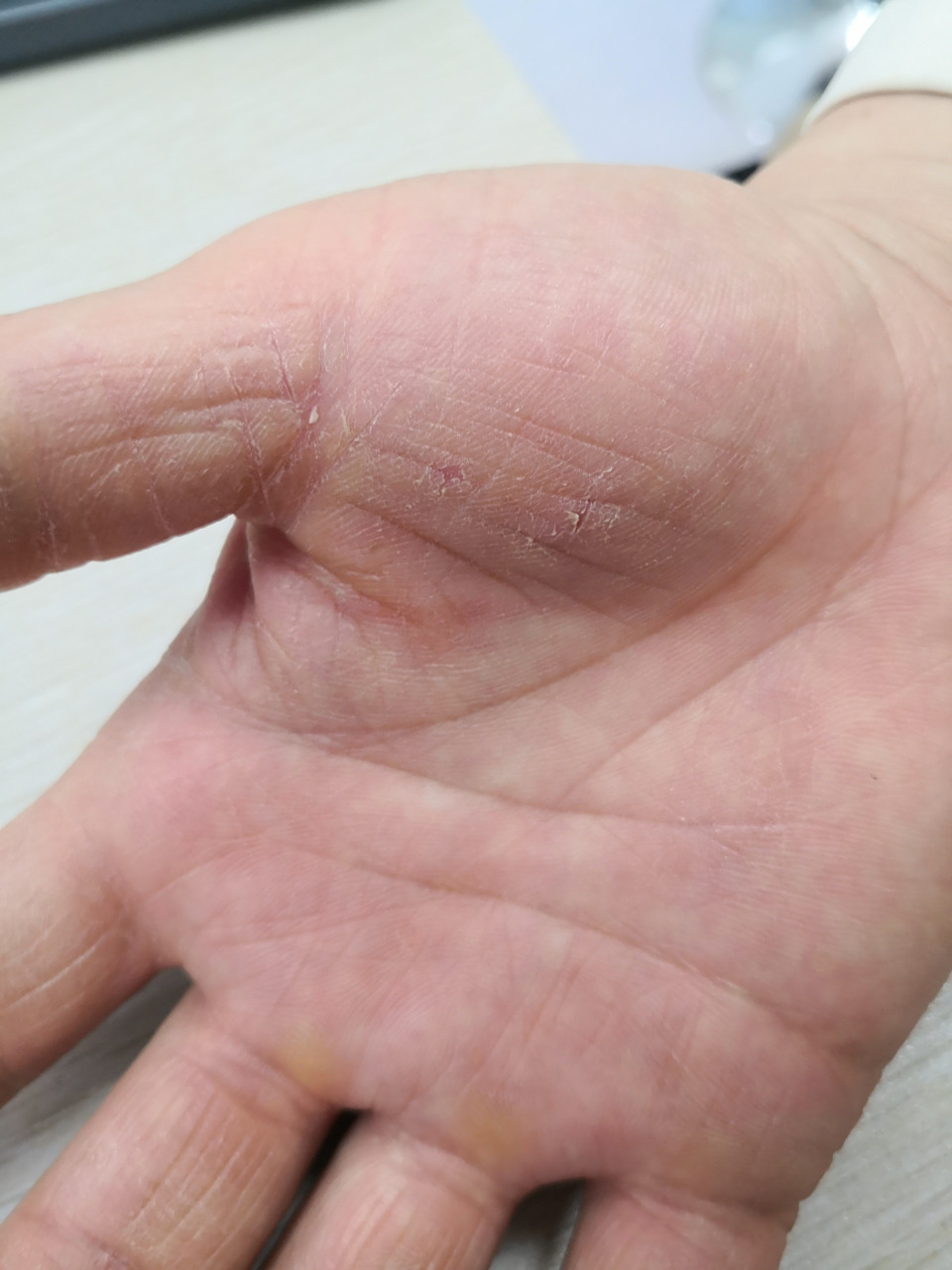 双侧手掌干燥脱屑角化过度症状.