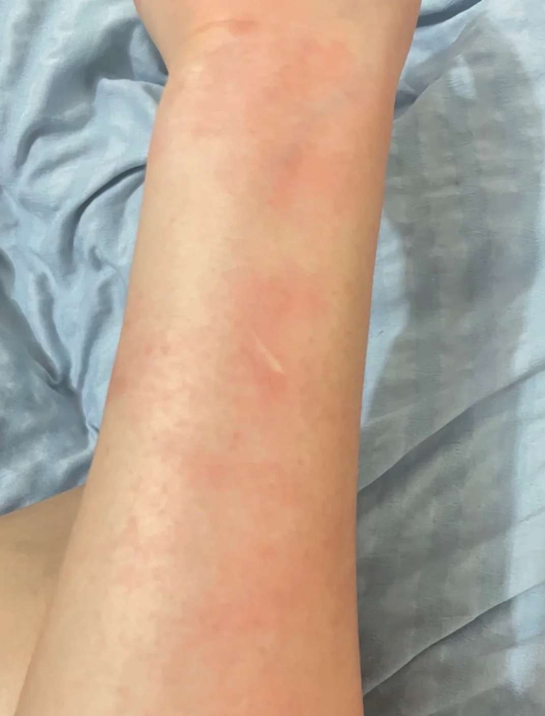 吃甲鱼过敏了怎么办?