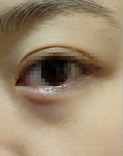 眼睛卧蚕下面长了个鼓包,可能由多种原因引起