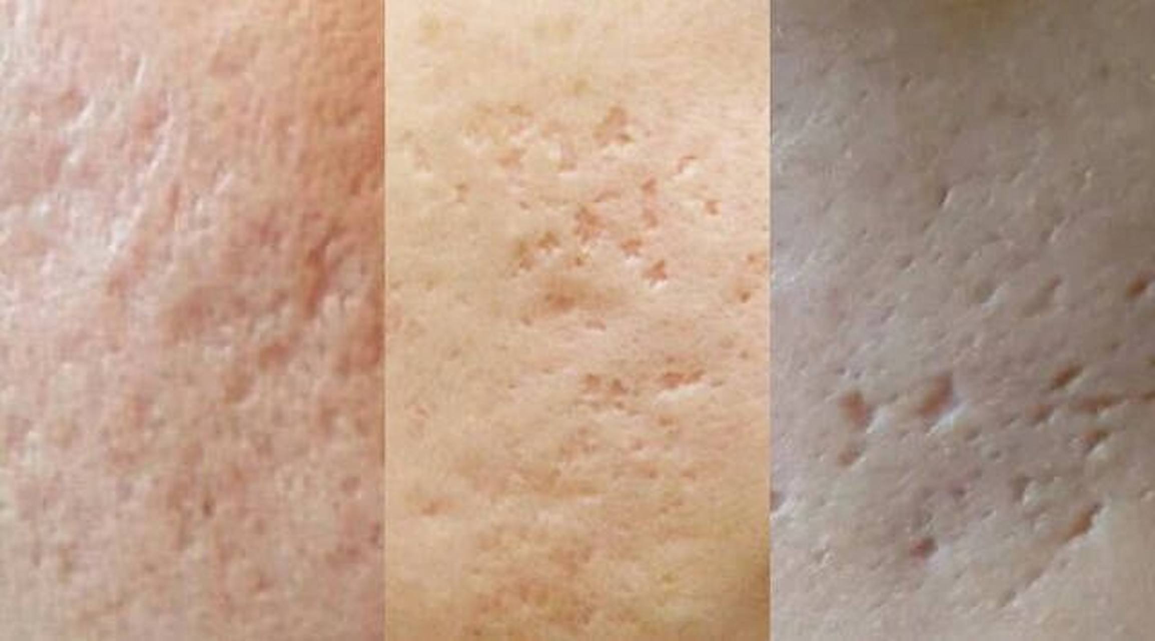 不同类型的痘坑,大小,深浅都不一样,治疗难度也不同.