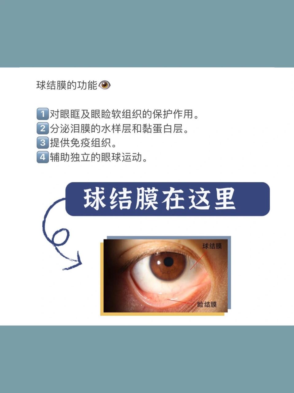 什么是睑裂斑71 睑裂斑是睑裂部接近角膜缘处的球结膜出现三角形