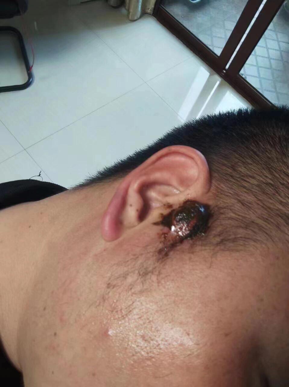耳前瘘管鼓包怎么办?