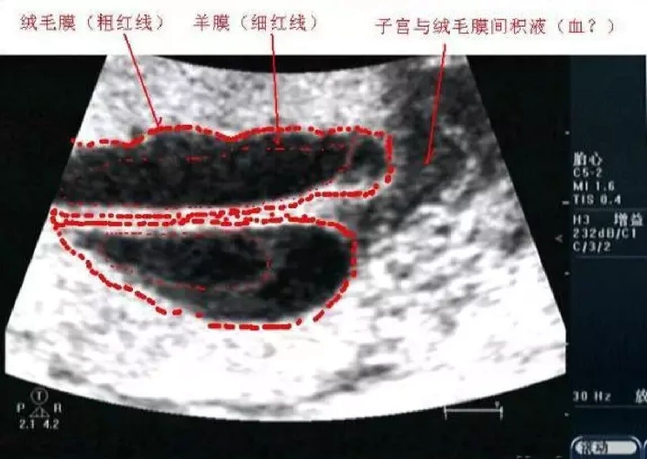 轮状胎盘图片超声图片