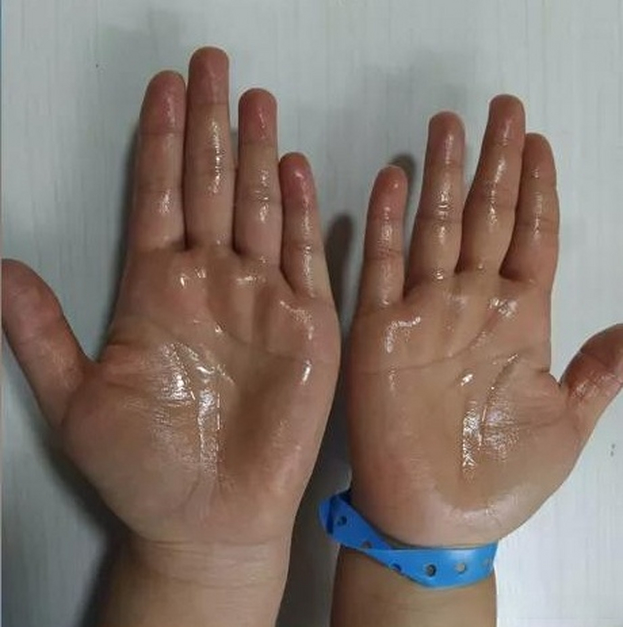 手汗症的原因是交感神经系统功能紊乱,导致汗腺分泌增加,引起的势掌