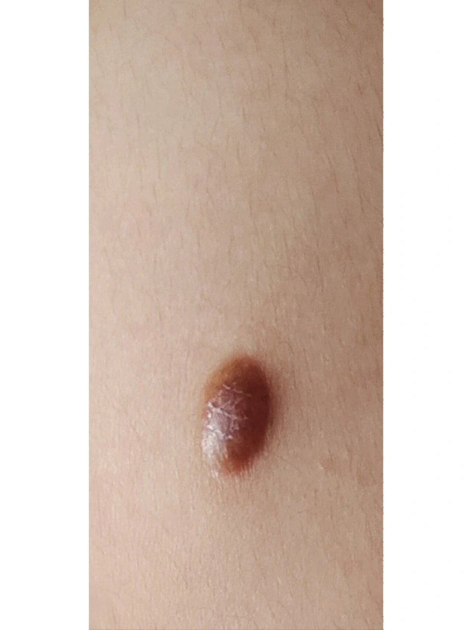 手臂上长了一个肉疙瘩,是个啥 摸上去硬硬的,用针戳也不流血,里面还有