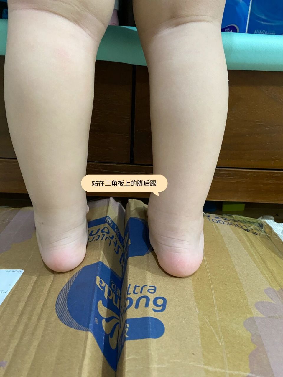 宝宝足外翻 看我家宝宝22个月足外翻,之前不到一周岁体检,儿保医生就