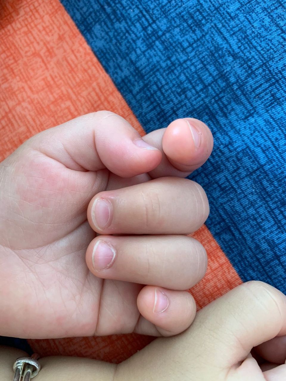 宝宝甲床越剪越短指甲越来越宽 有没有宝妈也跟我一样,很小时候就给剪