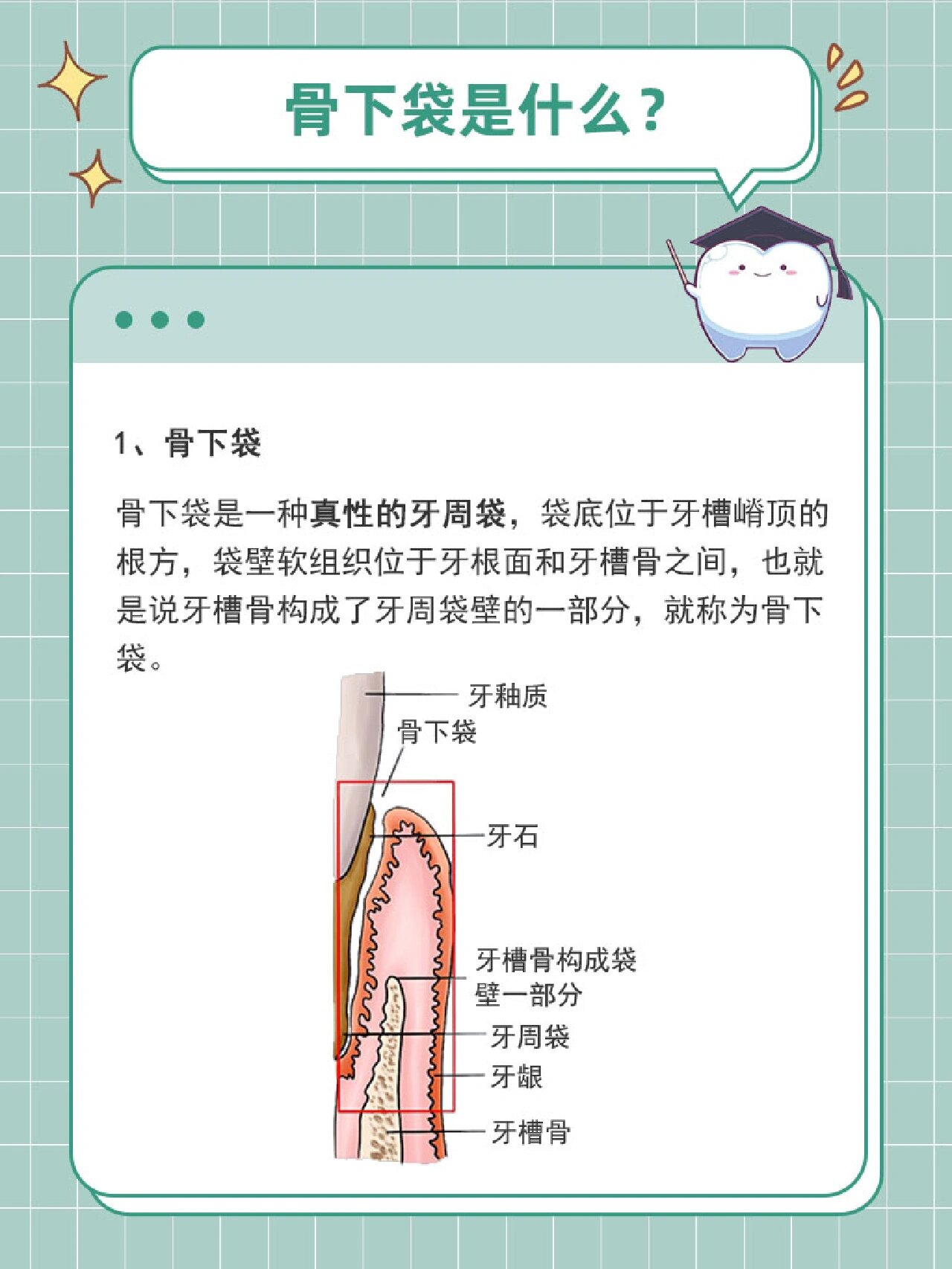 骨下袋是什么 骨下袋是一种真性的牙周袋,袋底位于牙槽嵴顶的根方,袋