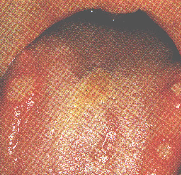 舌头根部出现红色疙瘩可能由多种原因引起