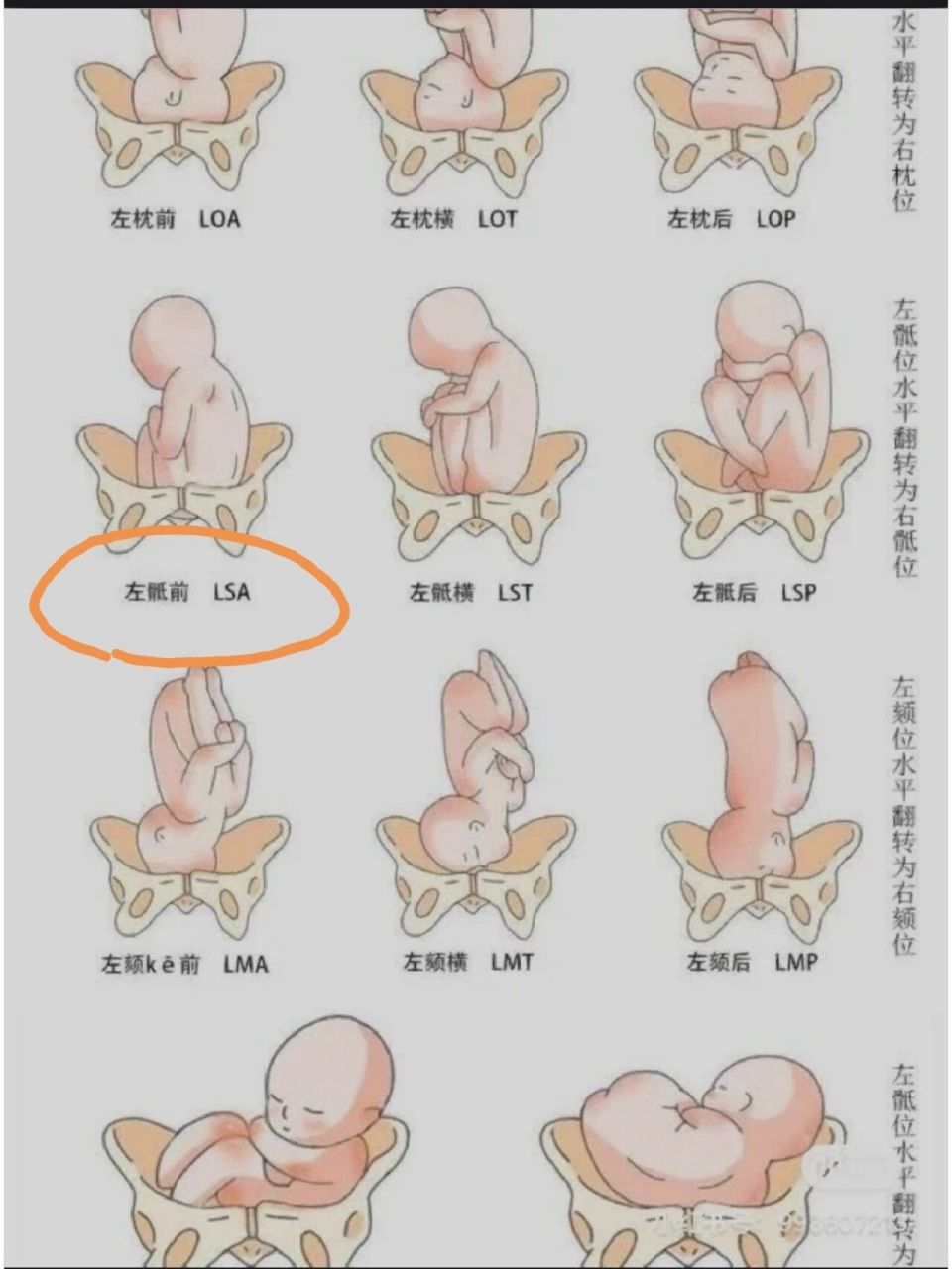 lsa胎位是什么意思图片