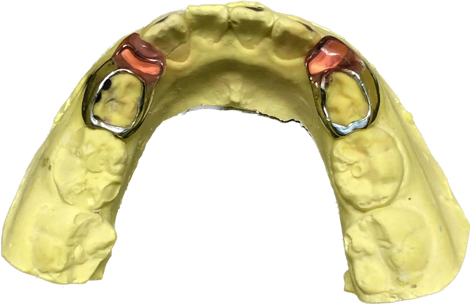 儿童牙齿阻萌器 11566早期萌出的恒牙可能与乳牙错位,即新长出的