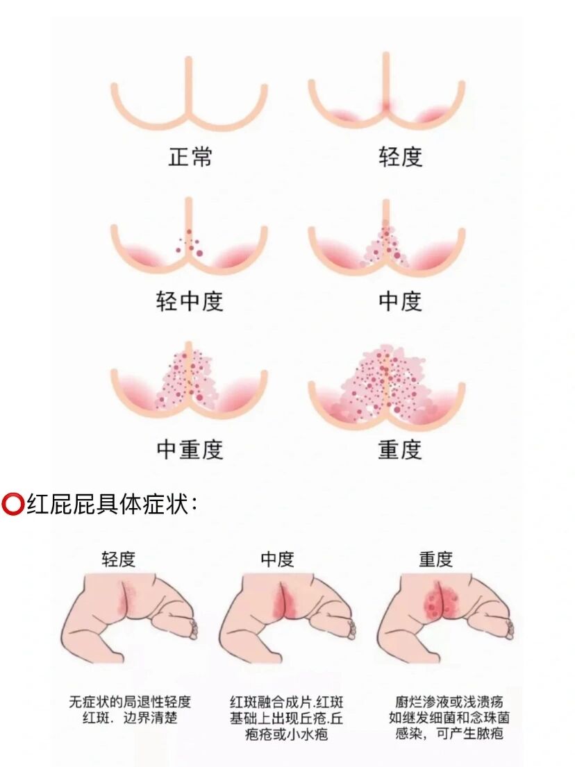 就是肛周一圈红,然后有好多小白点,像粉刺一样,这种情况持续了有一个
