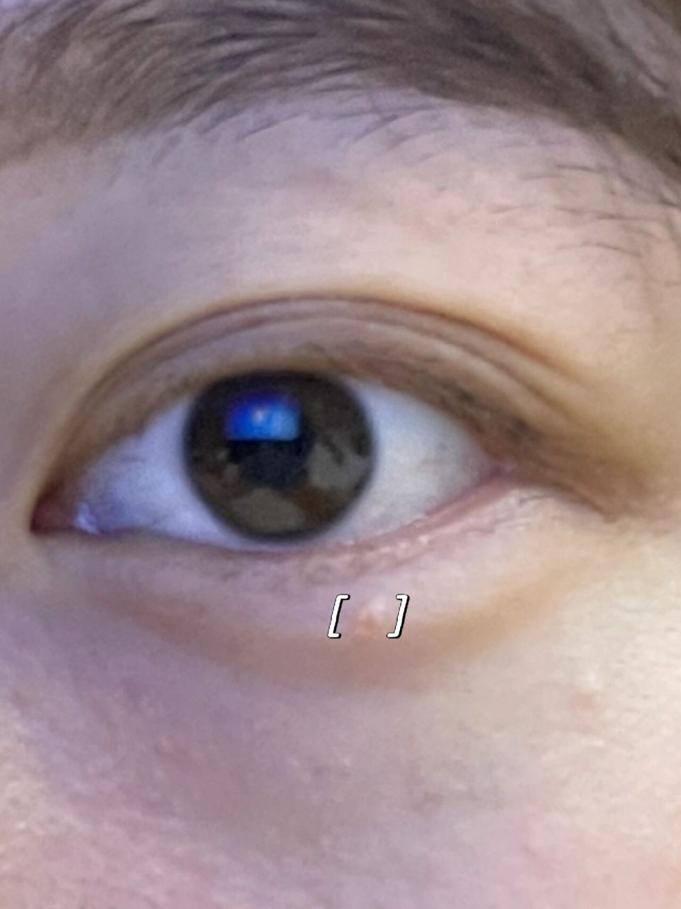 眼睛下面长了一个小粒粒 这个不知道是啥,有点像瘊子