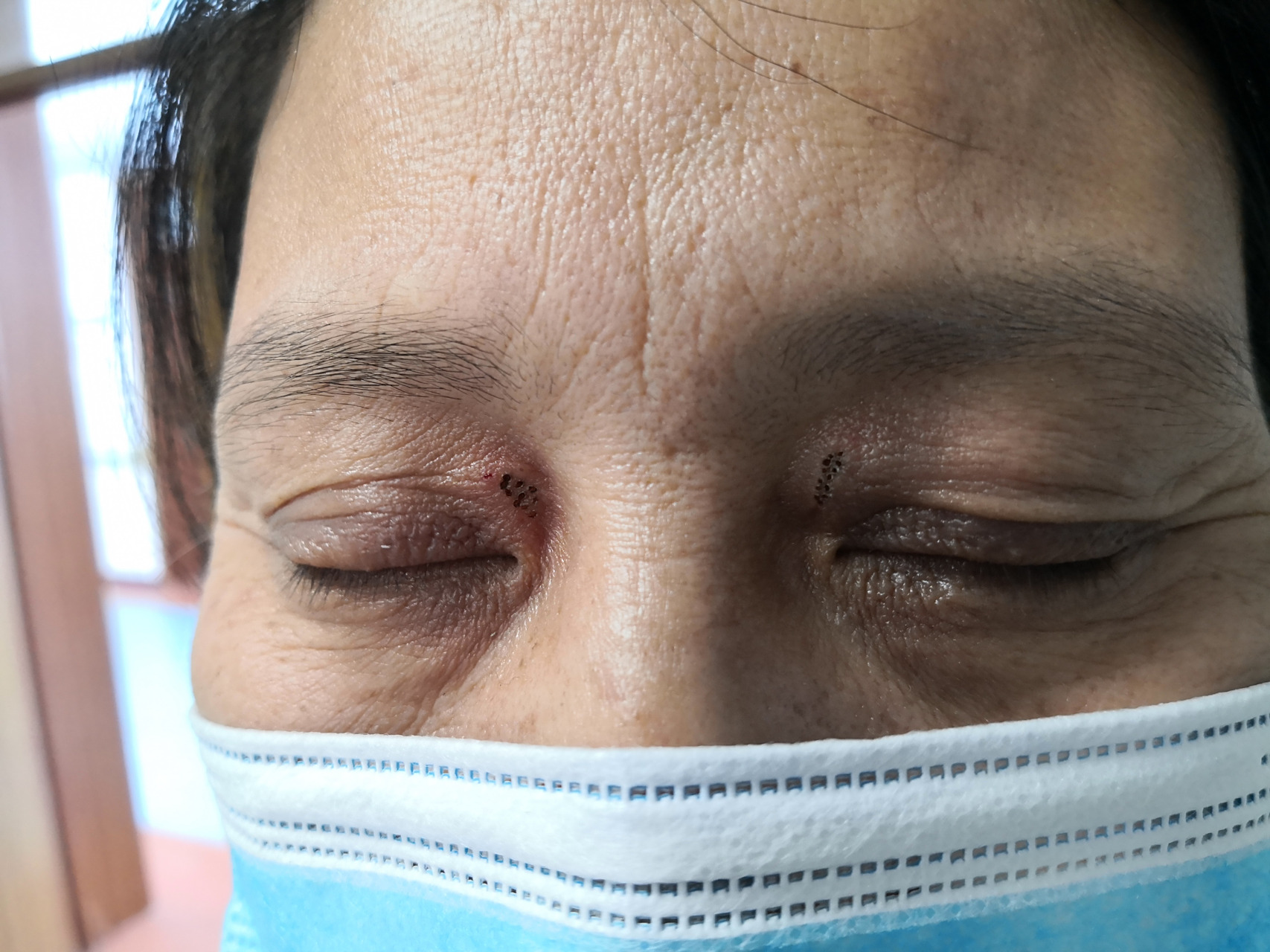 睑黄瘤激光治疗去除前后即刻图片.#美容##激光