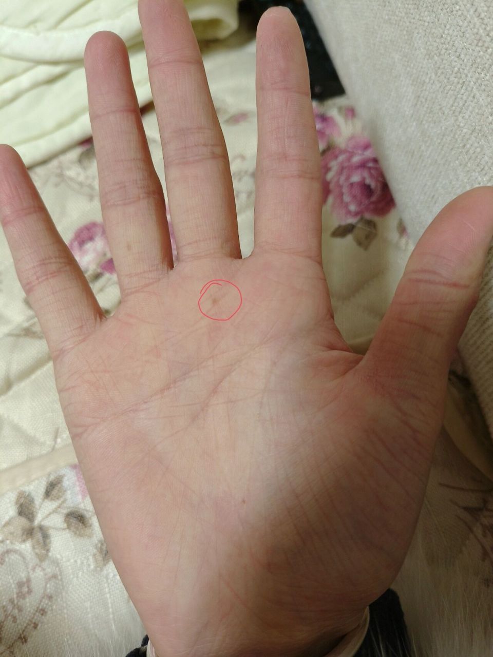手心突然长了痣 不知道啥时候 手心突然长了痣也不知道到底是不是痣