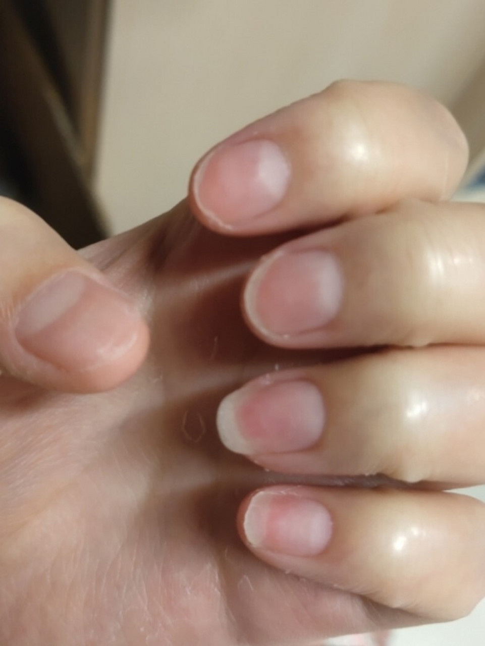 指甲分离 空甲详细恢复指甲过程 我在小红书上看到了很多有这种情况的