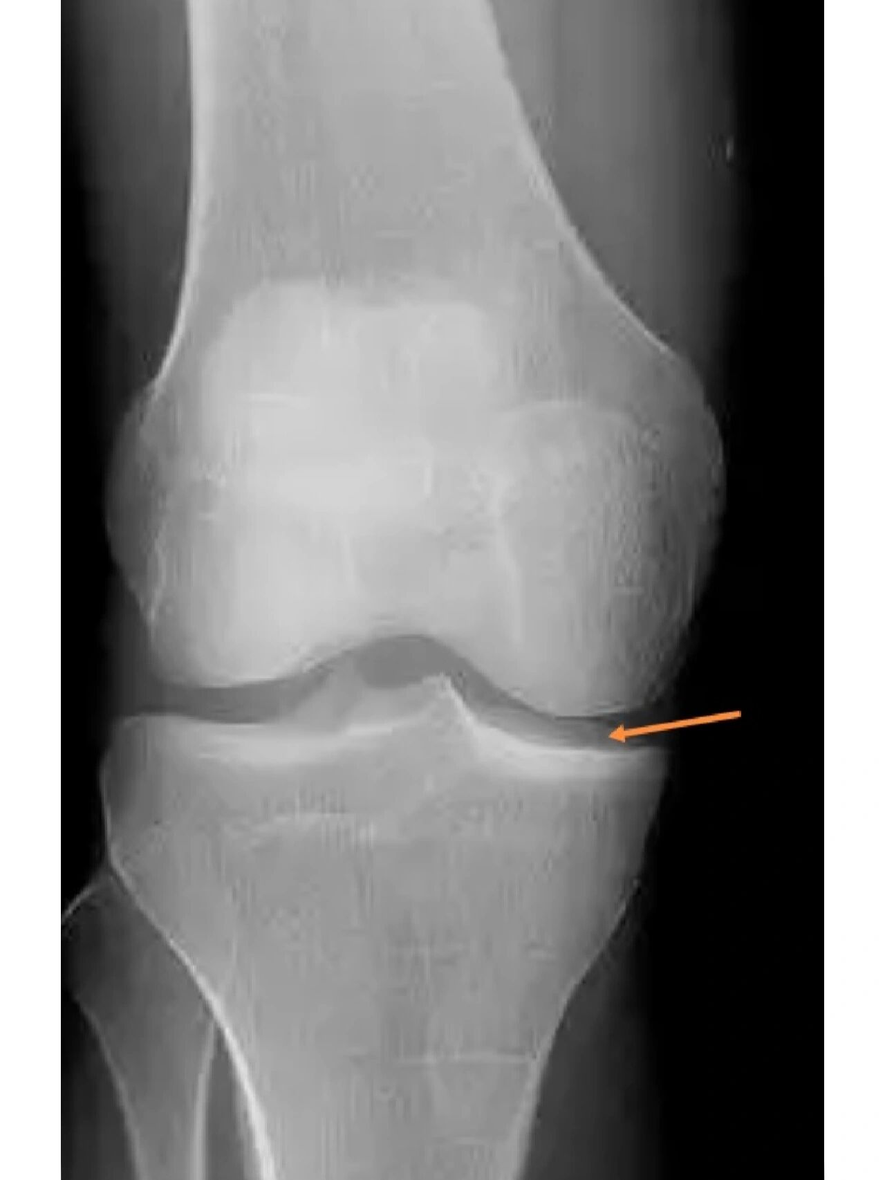 怎么拍出标准的膝关节正侧位片? 我们先来看看一张标准的膝关节正位.