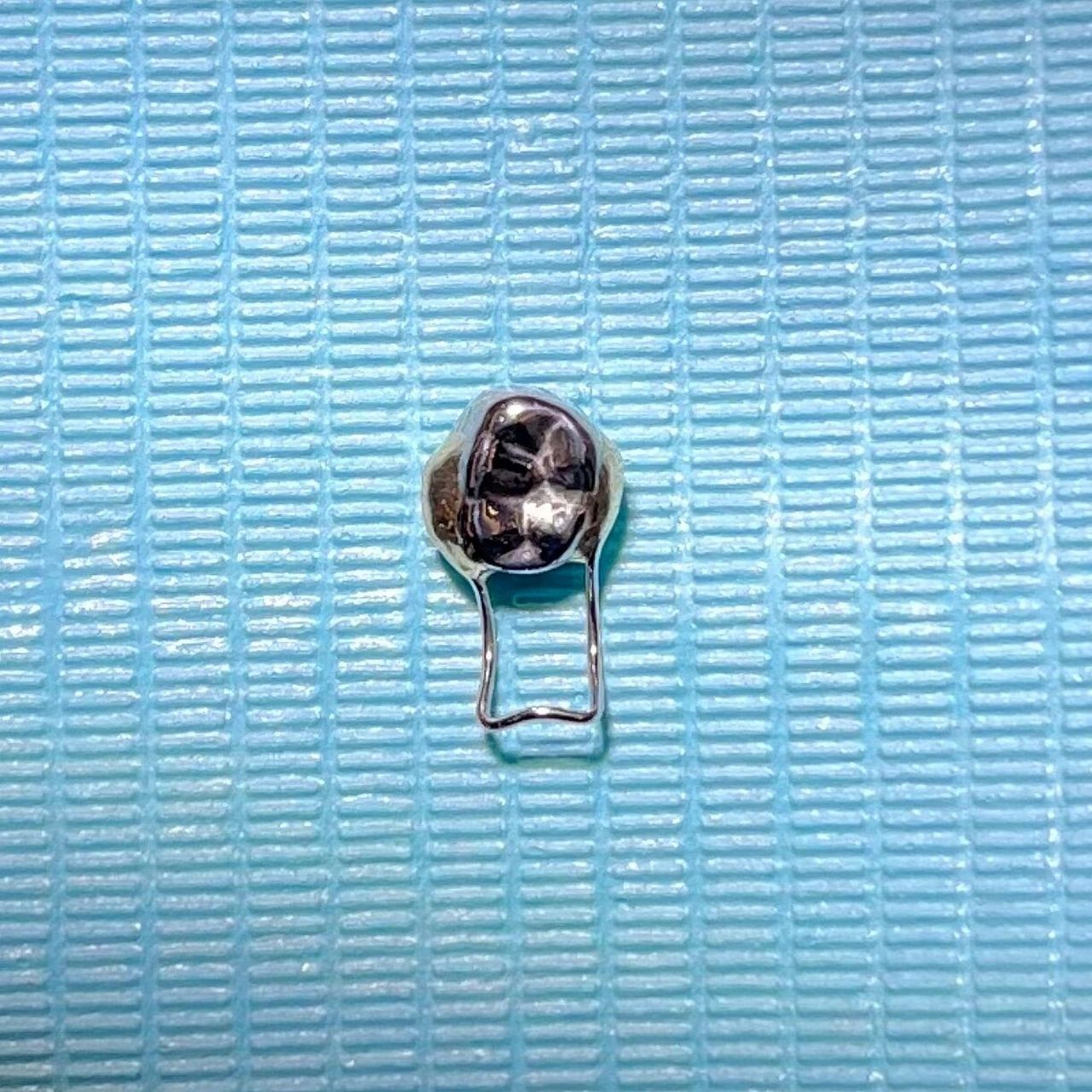 金属预成冠77间隙保持器 5岁小朋友因龋损时间久导致第一乳磨牙早失