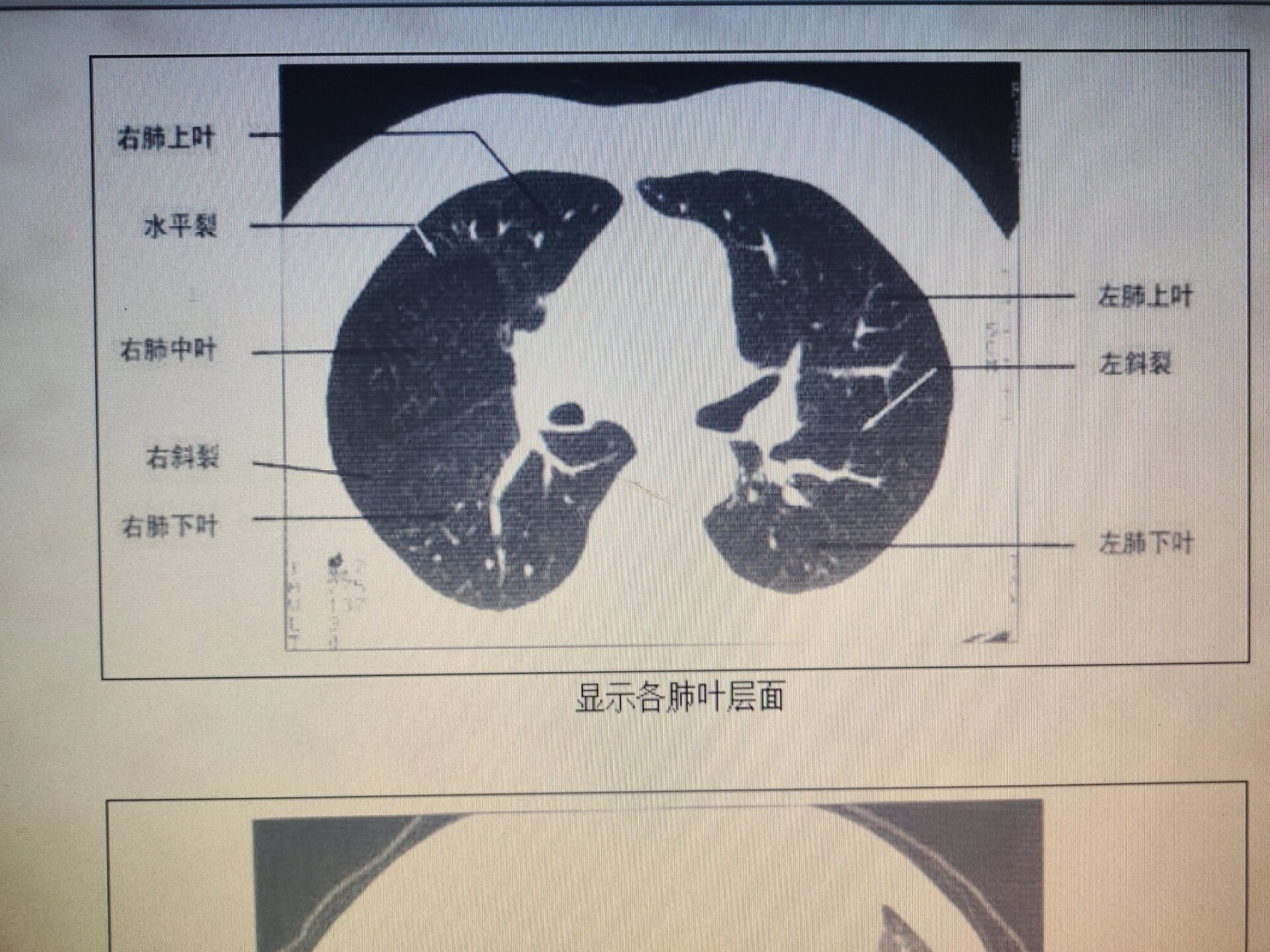 正常肺窗图片图片