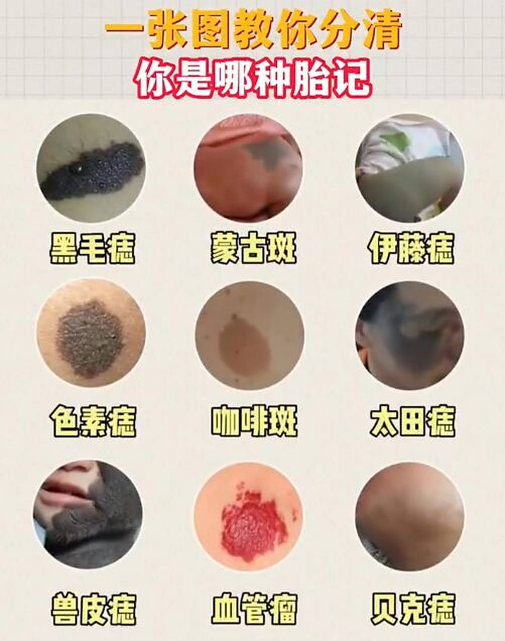 染色体突变引起,进而通过遗传体现在人的皮肤上,形成胎记 266环境活