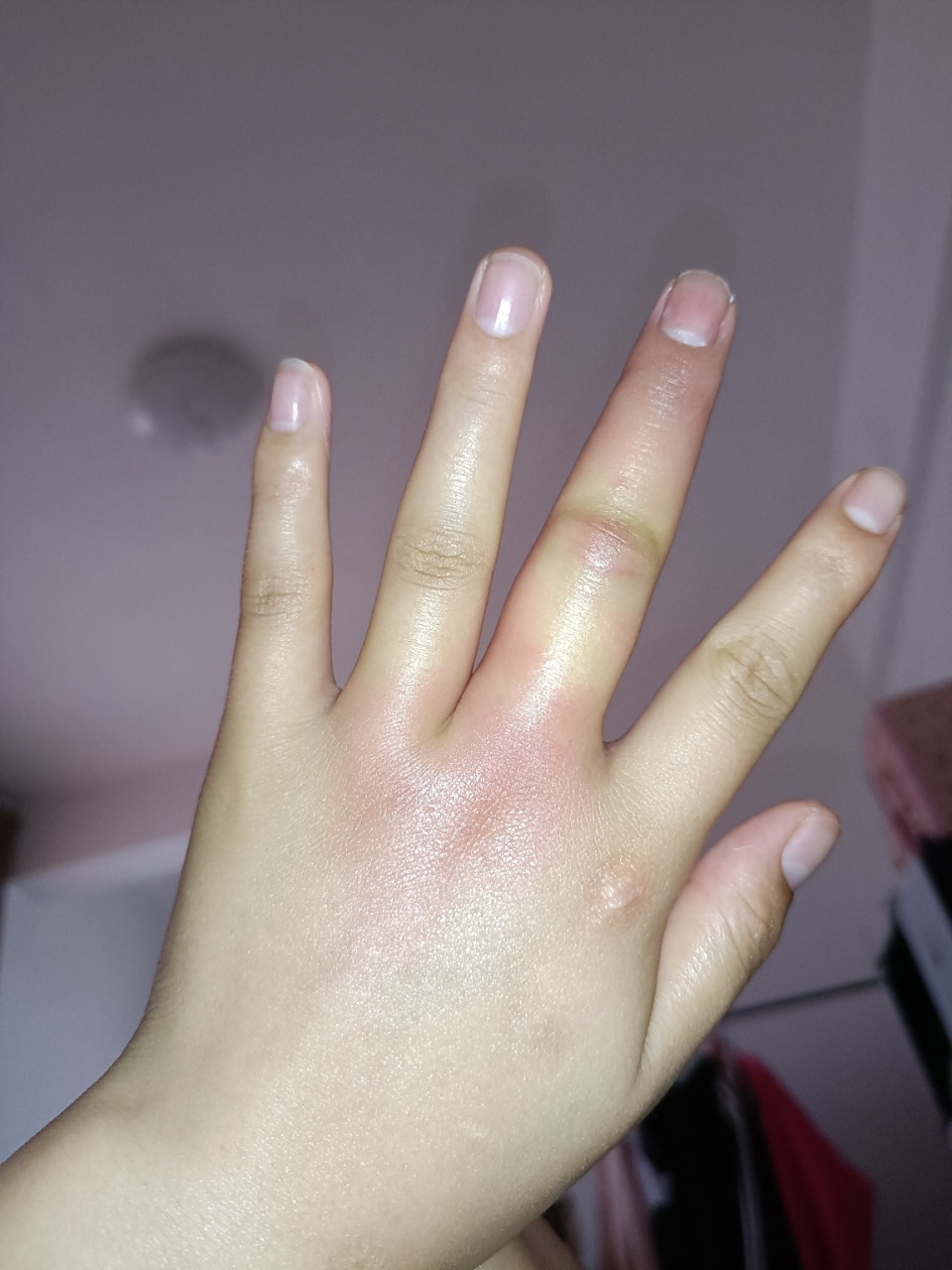 昨天被蜜蜂蜇了,今天就肿成这样 ,我太难了一晚上,又疼又痒又肿 ,要不