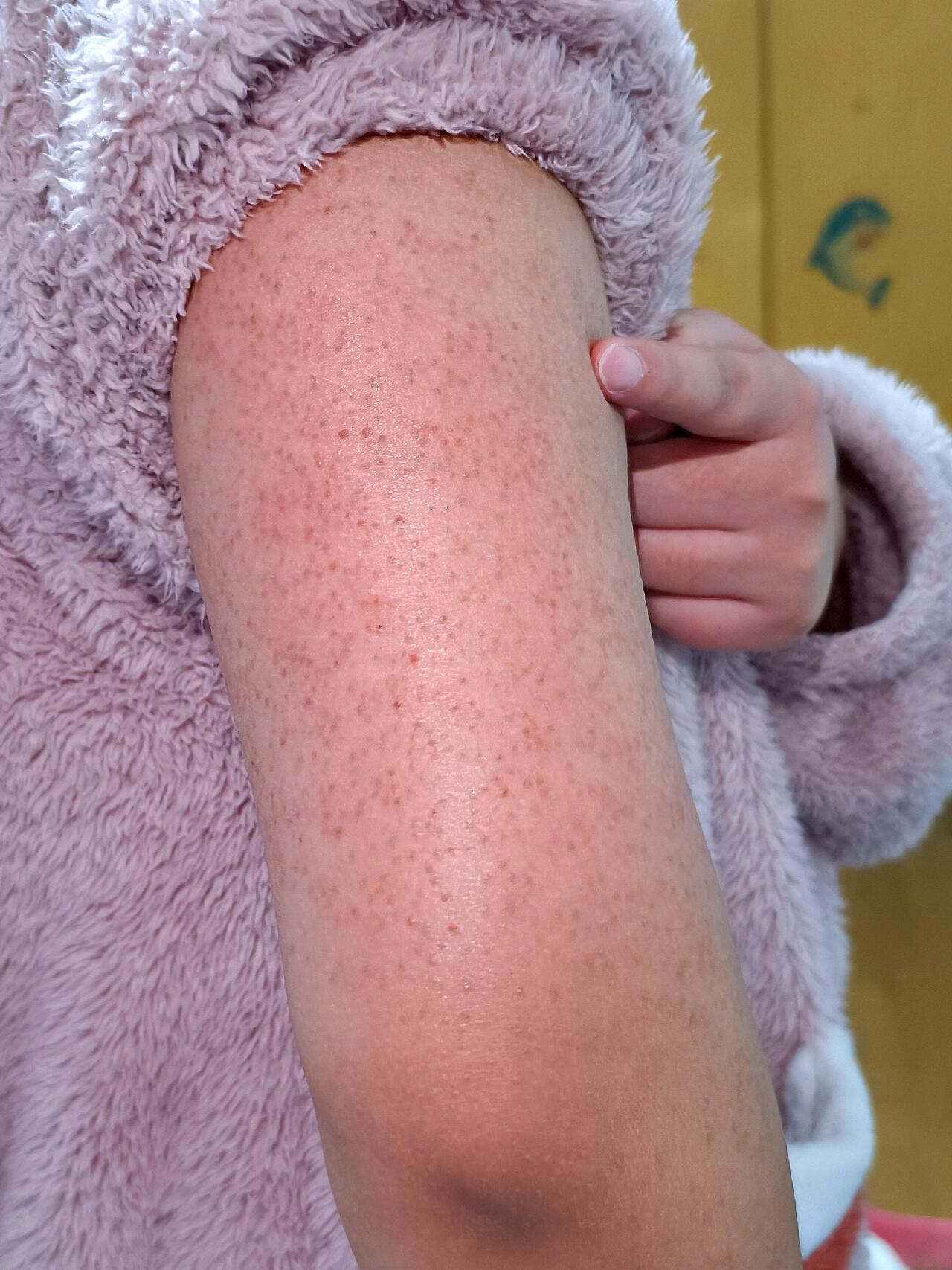 我就是天生的鸡皮肤,真的让人一言难尽 胳膊和腿上全是密密麻麻的小