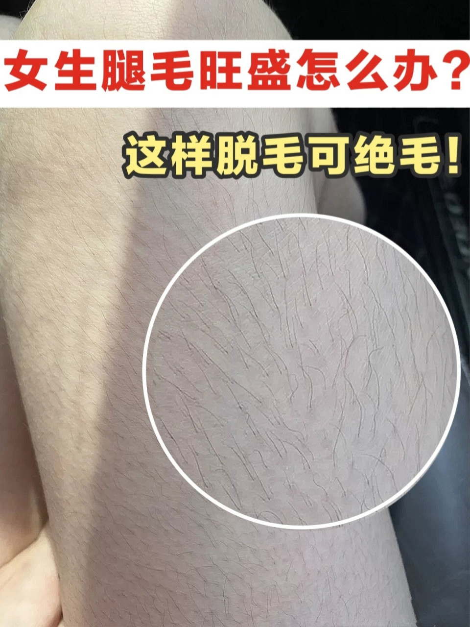 女生腿毛长很尴尬😭这样脱毛不再烦恼🔆 🍃女生腿毛旺盛是一种