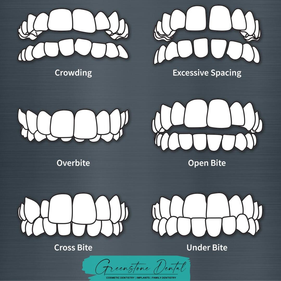 99牙齿错位大揭秘!爱笑的你,属于哪一种 嗨,小伙伴们!