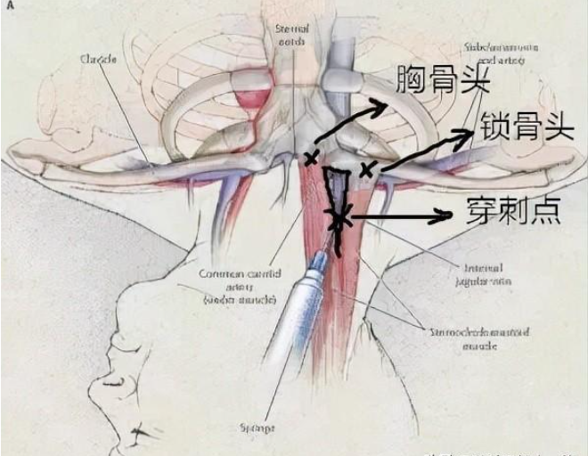 颈静脉位置示意图图片