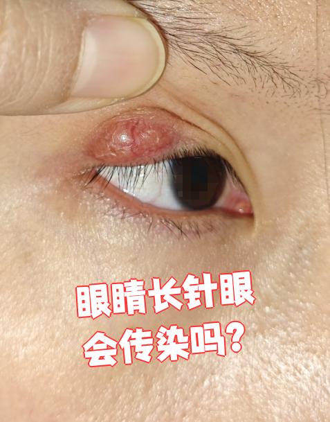 主要是葡萄球菌感染造成的,最常见的是金黄色