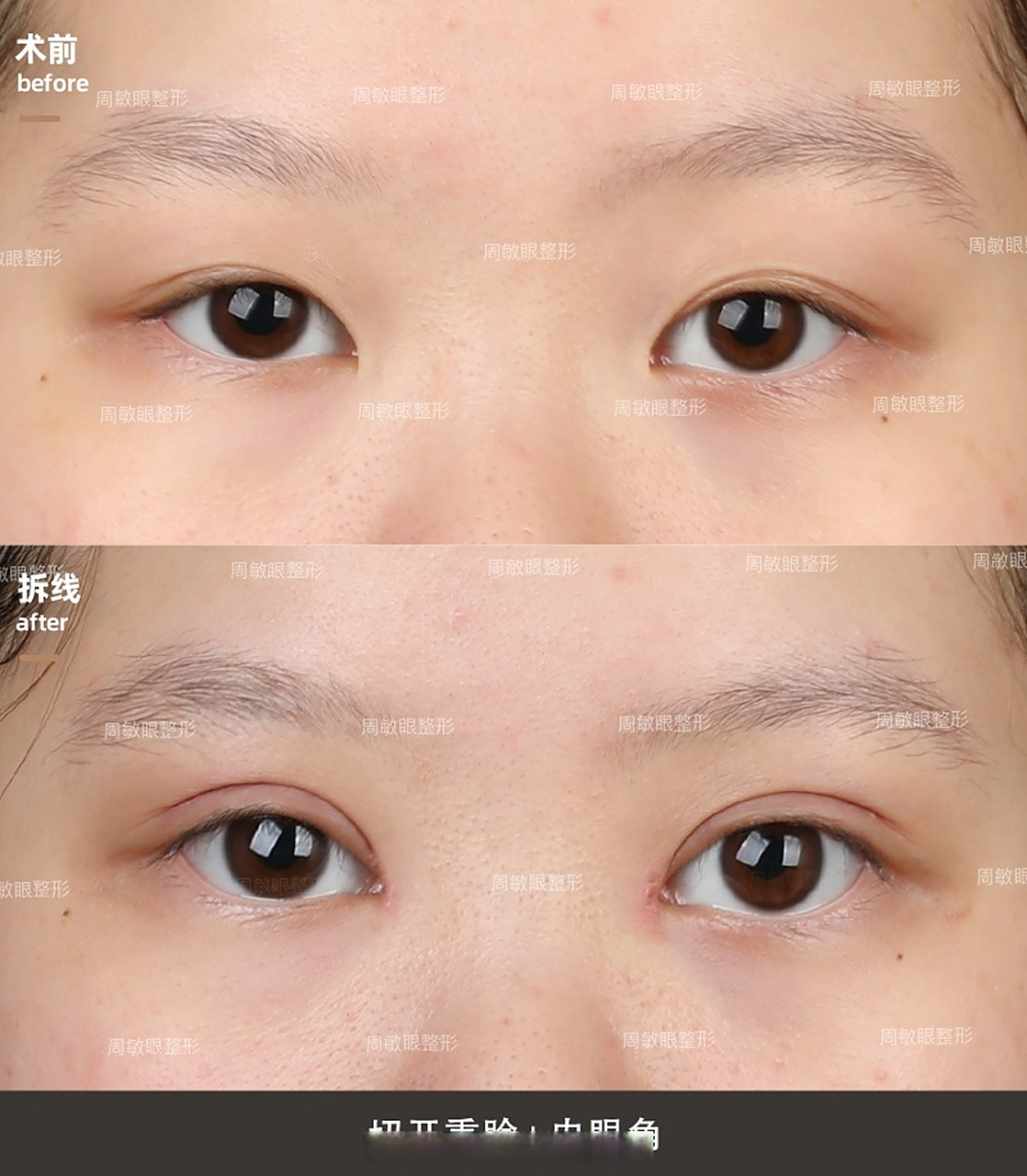 【全切双眼皮案例】双眼皮窄改宽 小美女术前双眼皮稍窄,皮肤松,脂肪